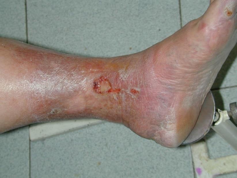 Ulcere Ferite che mostrano scarsa tendenza alla cicatrizzazione spontanea.
