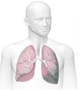 infectious pneumonia after occupational