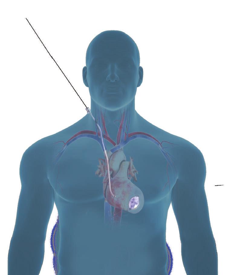 Il cardiologo interventista opera dal lato destro del collo attraverso la vena giugulare, mentre il chirurgo cardiotoracico opera
