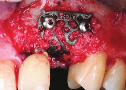 possono essere inseriti, o possono essere inseriti con maggiore difficoltà a causa di un volume osseo insufficiente.