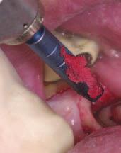 Le tecniche ricostruttive Bicon possono essere convenzionali o rivoluzionarie con la corona IAC Integrated Abutment Crown senza cemento né viti.