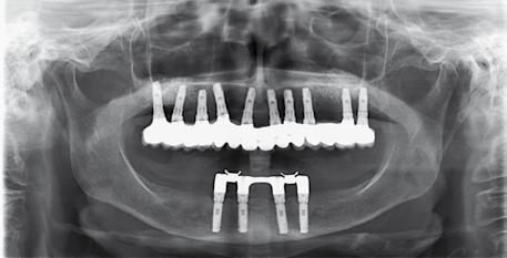 La ceratura iniziale e i provvisori aiutano il tecnico nel mantenimento degli spessori ideali per la stratificazione delle masse (Fig. 27). Si esegue la ceramizzazione degli elementi dentari (Fig.