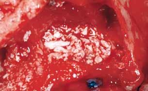 Zeppamento delle cavità sinusali: si comincia il riempimento dalla parete mediale in corrispondenza del versante palatino-nasale e distalmente ove il successivo inserimento degli impianti impedirebbe