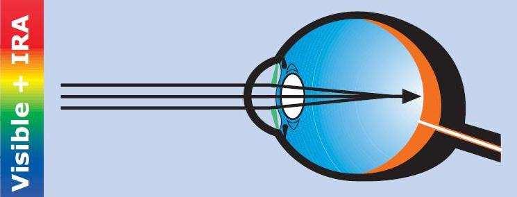 Danni alla retina da luce e IR-A Fotoretinite, danno su base fotochimica dovuto alla luce che raggiunge la retina: massima efficacia