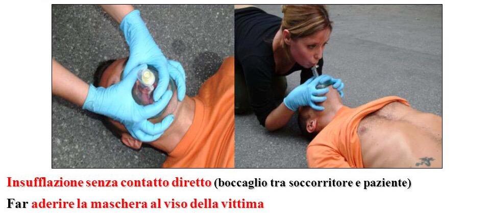 VA(2) = VA con 2 INSUFFLAZIONI di ARIA nei POLMONI BOCCA/BOCCA