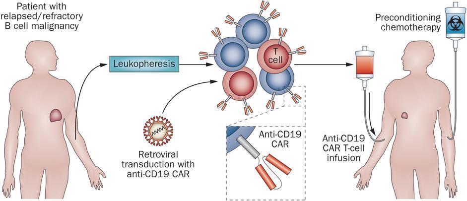 Chimeric antigen receptor T (CAR-T) cells: NUOVA FRONTIERA DI CURA Le cellule CAR-T vengono prodotte per ogni singolo paziente, utilizzando le sue stesse cellule.