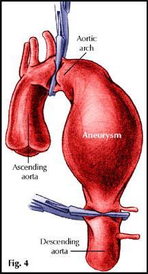 Manifestazioni della sindrome di Marfan Disturbi cardiovascolari disturbi più gravi Dilatazione dell aorta.