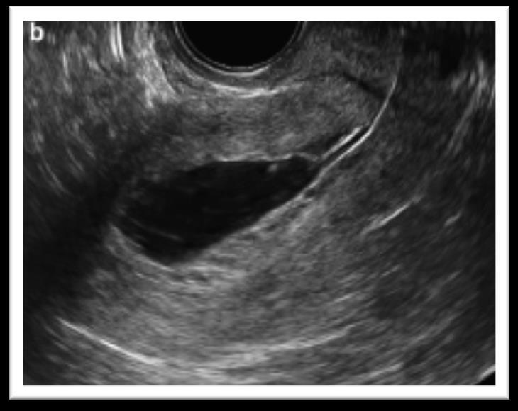 caratteristiche ecografiche che permettono di diagnosticare con