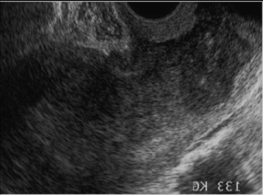 Endometrial cancer stage II.