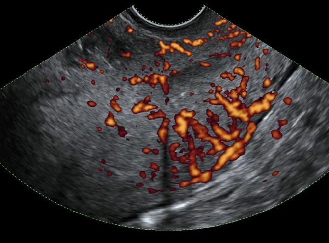 Endometrial cancer stage II.