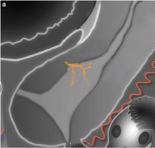 Low-risk endometrial cancer