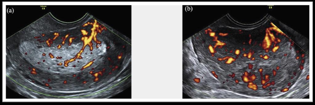 Vascolarizzazione e ecogenicità Low risk più spesso iperecogeni color score 1 o 2 e vaso singolo o multiplo ma con