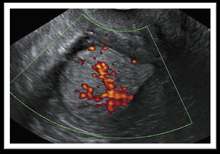 Pitfalls: Ci può aiutare iperecogenicità e vascolarizzazione Endometrial cancer