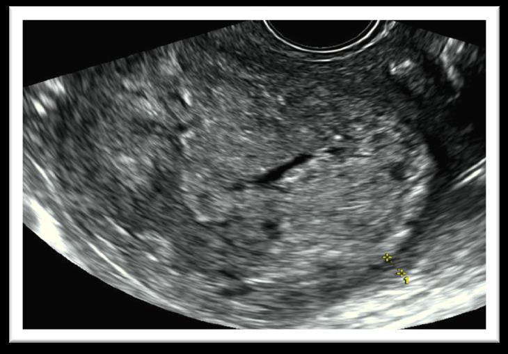 Histology confirm myometrial invasion less than 50% Endometrial cancer stage 1B.