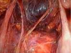 del linfonodo sentinella Isterectomia totale extrafasciale laparoscopica per carcinoma endometriale Isterectomia totale/radicale in