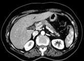 evidence of primary tumor Carcinoma in situ Tumor limited to the pancreas, 2 cm in greatest dimension Tumor limited to the pancreas, >2 cm in greatest dimension Tumor extends beyond the pancreas