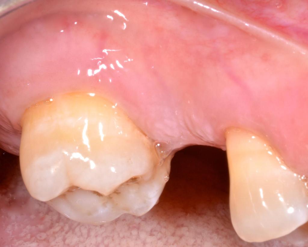 Messa al corrente dei benefici della chirurgia guidata, e dall assenza di dolore che essa avrebbe garantito, si è fortemente convinta di volere risolvere con questa tecnica