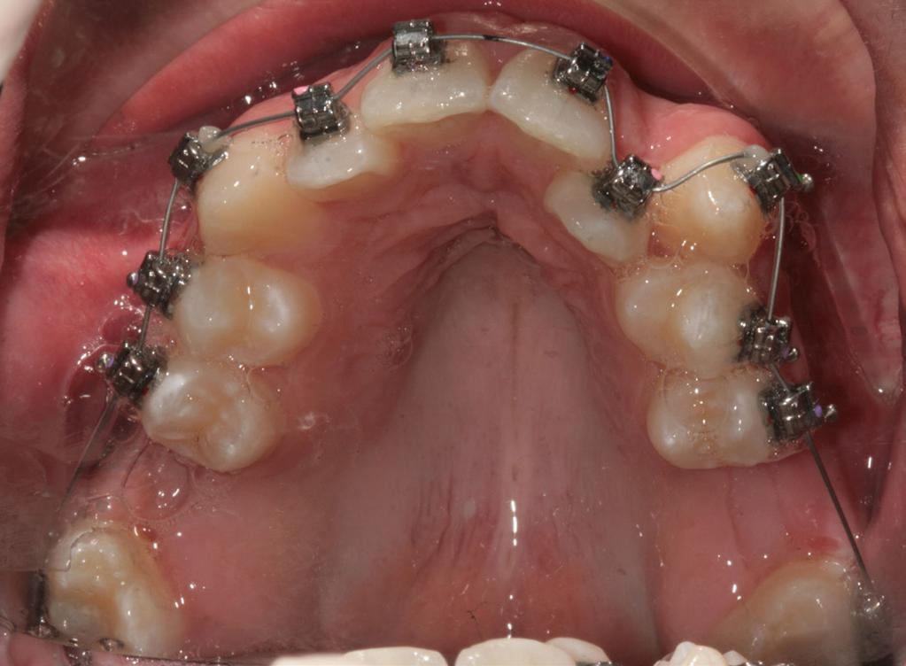 5 mm Secondi premolari: 4 mm Secondi molari: 3.5 mm Risultato dopo 4 mesi di terapia. Il caso non ha avuto bisogno di riposizionamenti (Fig. 5-8). Fig. 5 Fig. 7 Fig. 6 Fig.