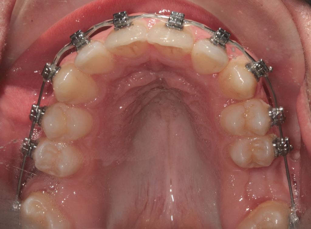 CONCLUSIONI Il corretto posizionamento dei brackets SW è un passaggio delicato nel trattamento ortodontico e può risultare problematico sia per colleghi esperti che principianti.