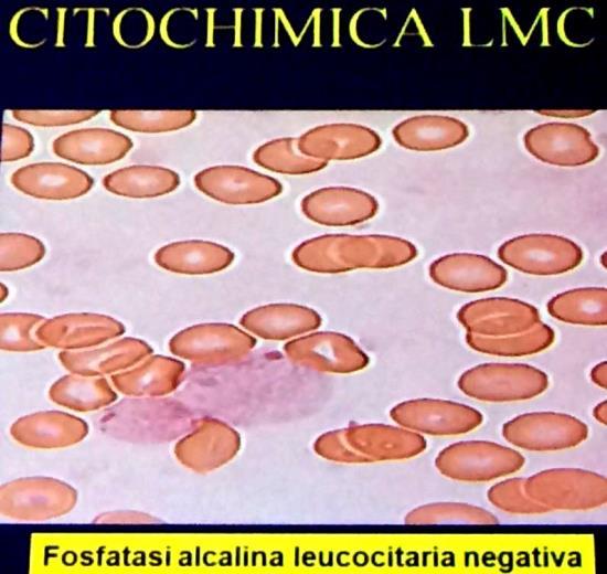 midollo, una Policitemia Vera dalla Trombocitemia essenziale, mentre il problema [di diagnostica differenziale] della LMC si pone di più con la Mielofibrosi in fase cellulare.