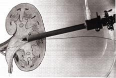PCNL PerCutaneous Nephro Lithotomy è una tecnica endourologica che permette di accedere alle cavità renali attraverso un tragitto percutaneo realizzato