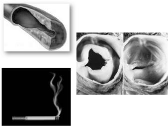 Quadri morfologici Aneurisma fusiforme: dilatazione simmetrica che coinvolge l intera circonferenza della parete aortica (aorta ascendente + arco; arco + aorta discendente; arco isolato (più raro)