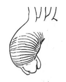Sostituzione dell aorta ascendente In caso di aneurisma del tratto ascendente tubulare, con normale diametro