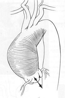 e valvola aortica (Wheat) In caso di aneurisma del tratto ascendente tubulare con normale diametro radice +