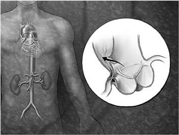 Evoluzione Le cause di mortalità sono legate alle: complicanze ischemiche da compressione del vero lume da parte del falso a livello di: valvola aortica (con insufficienza aortica acuta, 15 55%)