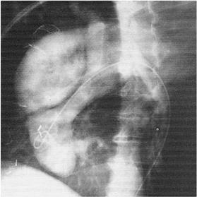 Diagnosi strumentale Esame angiografico (aortografia): visualizzazione lume (possibile evidenza flap)