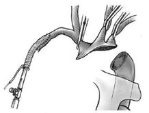 Plesso brachiale Arteria ascellare Grande