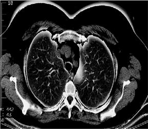 Al confine con l aorta toracica si può trovare un piccolo restringimento istmo dell aorta seguito da una dilatazione.