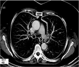 discendente Patologie chirurgiche dell aorta toracica Aneurismi: del bulbo aortico e dell aorta ascendente