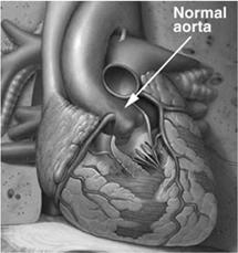 Definizioni e terminologia Malattia dilatativa dell aorta: processo patologico caratterizzato dall aumento del diametro del lume aortico, che può
