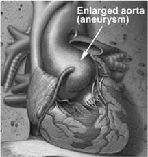 Dilatazione (o ectasia): aumento del diametro aortico rispetto ai valori normali per età e superficie corporea.