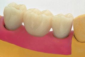 715 N. articolo 048.716 N. articolo 048.717 N. articolo 048.718 corona ponte Questo restauro provvisorio può essere realizzato facoltativamente dal dentista direttamente durante l intervento o dall odontotecnico in laboratorio.