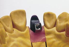 Usare la chiave in silicone del wax-up per controllare la forma della struttura. La modellazione è eseguita su un modello in scala del dente.