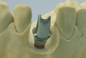 Nota: se si sceglie di ceramizzare direttamente la componente secondaria in oro RN synocta occorre verificare che la lega di fusione dentale disponga di uno spessore sufficiente di metallo.