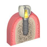 Torque di serraggio = 35 Ncm! C) Inserimento della protesi definitiva Il restauro viene consegnato al dentista con la componente secondaria su misura sul modello master.