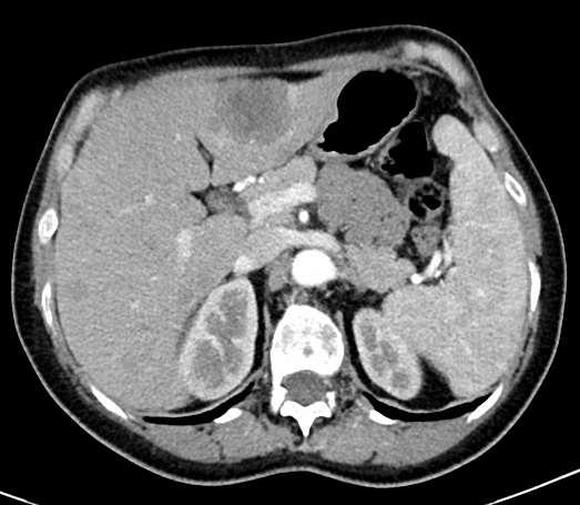 ANAMNESI ONCOLOGICA (2): MALATTIA METASTATICA 03/2013: RT locoregionale su parete toracica e stazioni linfonodali Test genetico: mutazione del gene BRCA2 03/02/2014: