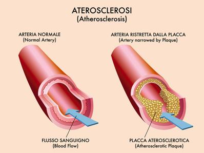 Accanto allo svilupparsi di ipertensione arteriosa sistolica (cui abbiamo accennato sopra), le alterazioni descritte a carico della parete vascolare sono responsabili di aterosclerosi, che può