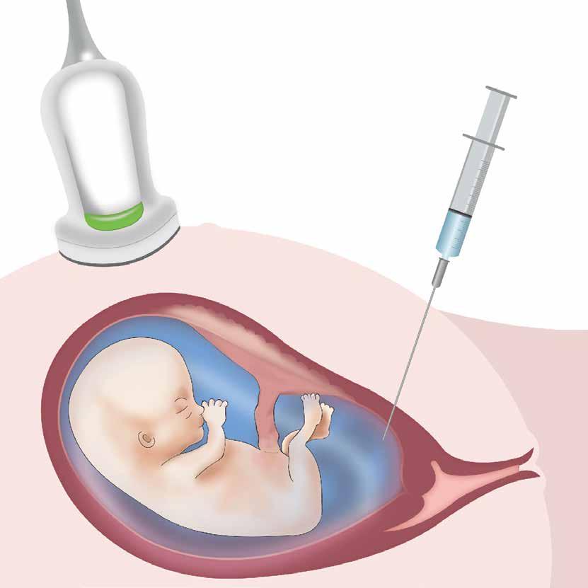 Diagnostica invasiva Villocentesi ed amniocentesi Procedura diagnostica L età avanzata della madre o un test combinato che indichi rischio elevato possono rendere necessaria una procedura invasiva,