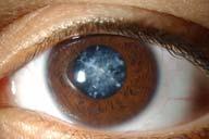 CATARATTA GLAUCOMA