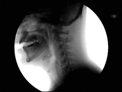 ad alterata coordinazione della biomeccanica deglutitoria