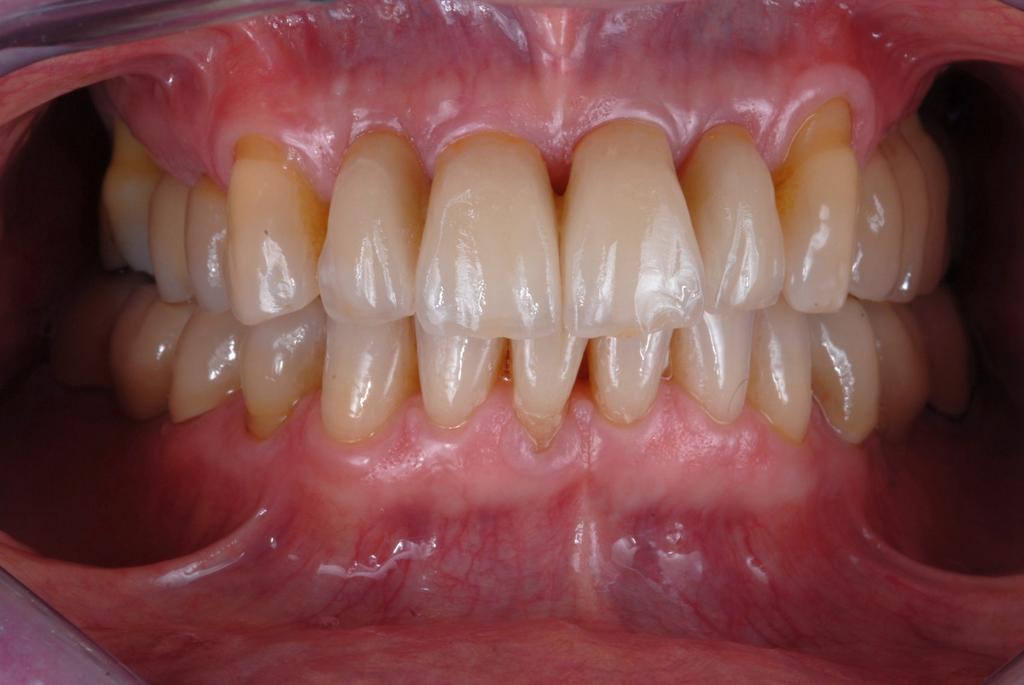 Protocolli relativi all inserimento di impianti postestrattivi immediati mediante chirurgia