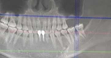 RIALZO CRESTALE DEL PAVIMENTO DEL SENO Doppio rialzo crestale del pavimento del seno Dr.