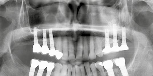 RIALZO DEL PAVIMENTO DEL SENO E INCREMENTO OSSEO Rialzo laterale del pavimento del seno con follow-up di 20 anni Dr.