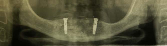 ritenute, ovvero dentiere stabilizzate da impianti con un attacco a pallina in testa sul quale una femmina incorporata nella dentiera trova stabilizzazione (Casi 1,2,3,4,) - le OVERDENTURE impianto