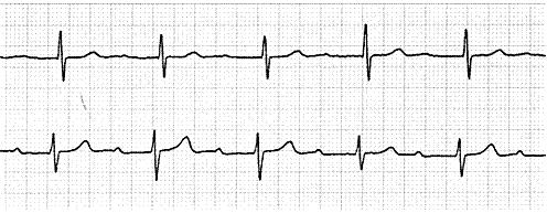 Aritmie ipocinetiche o