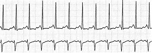 Aritmie ipercinetiche o